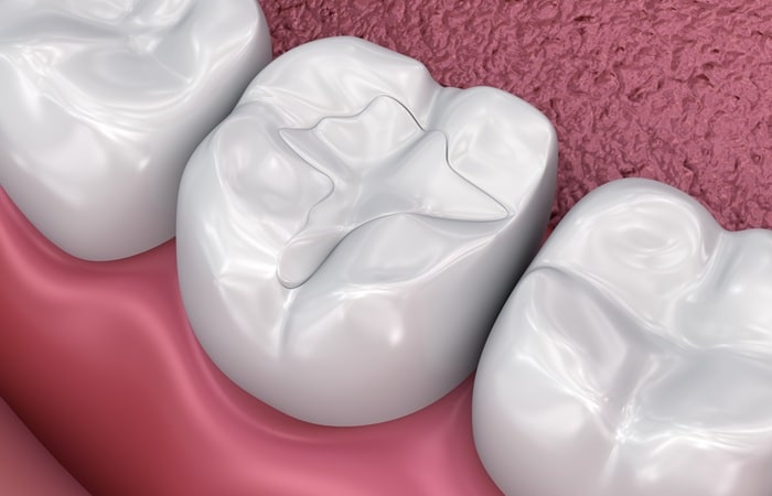 dental-fillings-ebbers-family-dental