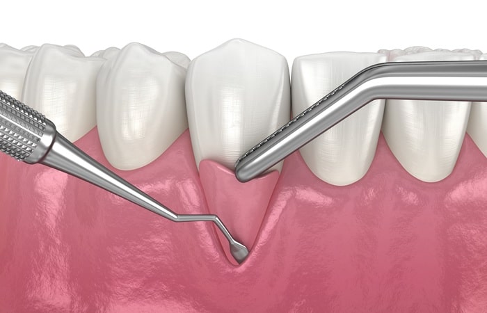 gum-grafting-ebbers-family-dental